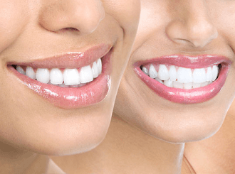 Porcelain Crowns Brighton Dental Office